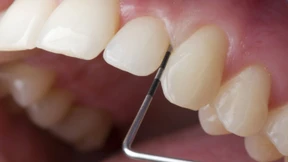 Was hat Zahnfleisch mit Alzheimer zu tun?