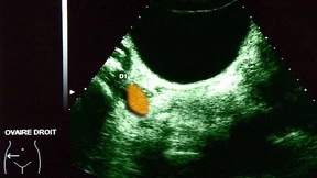 Diese mRNA-Waffe räumt Tumore aus dem Weg