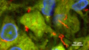 Mehr Deutsche erkranken an Syphilis