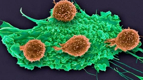 Mit CAR-T-Zellen gegen aggressiven Hirntumor