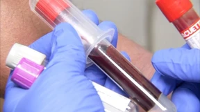 Neuer Bluttest zur Brustkrebsdiagnose