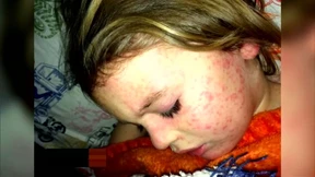 Masern-Notstand in Washington