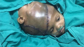 Ärzte trennen am Kopf zusammengewachsene Zwillinge