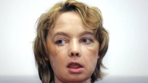 Erste Frau mit transplantiertem Gesicht gestorben