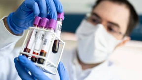 „Viele unerkannte Corona-Infektionen“