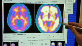 Immunzellen werden zur Gefahr für Nervenfasern