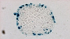 Gefährliche körpereigene Krebsabwehr