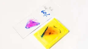 Krebsoperationen nach Fehldiagnose?