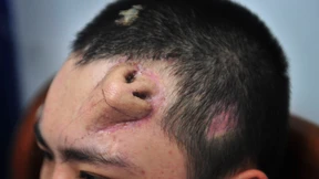 Neue Nase für Chinesen wächst vorerst an der Stirn