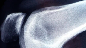 So gut kann ein neues Knie passen