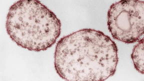Stündlich sterben 15 Menschen an Masern