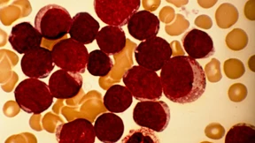 Akute Leukämie besser behandeln