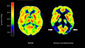 Sind Alzheimer-Mittel wirklich nicht nützlich?