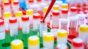 Brustkrebs-Bluttest: Durchbruch oder Enttäuschung?