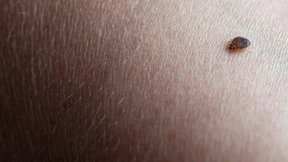 Bettwanzenplage in französischen Haushalten