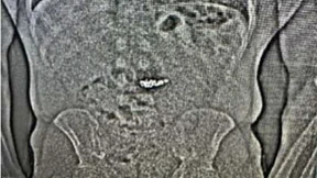 Dieb verschluckt Ohrringe für mehr als 700.000 Dollar