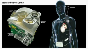 Kunstherz macht Patienten Hoffnung 