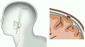 Elon Musk will dem Mensch ans Hirn