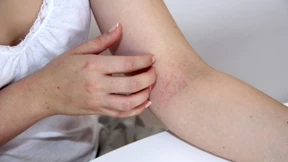 Wenn die Haut chronisch juckt