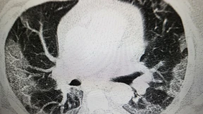 Wie sich eine Corona-Lungenfibrose früher erkennen lässt