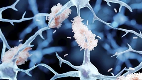 „Das ist ein echter Durchbruch in der Alzheimerforschung“