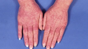 Neue Behandlungsmethode für Autoimmunkranke