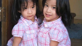 Siamesische Zwillinge erfolgreich getrennt