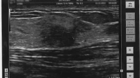 Die Liebe und der Krebs