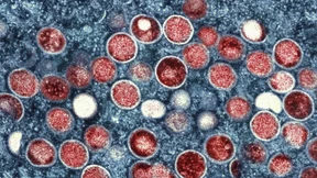 Vierjährige aus Pforzheim hat doch keine Affenpocken