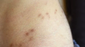 Strengere Meldepflicht für Hautkrankheit