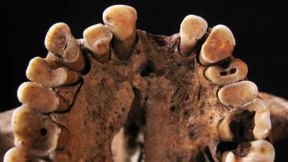 Auch frühe Jäger hatten Karies