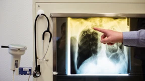 Tuberkulose bleibt weltweit die Infektionskrankheit mit den meisten Todesfällen