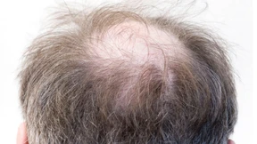 Haarausfall ist kein Schicksal mehr