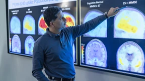 Ein „Meilenstein“ im Kampf gegen Alzheimer?