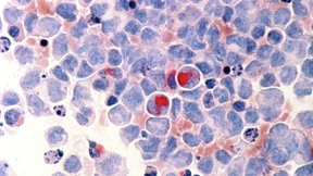 Wie Leukämiezellen durch Recycling besser wachsen