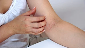 Neue Medikamente gegen Juckreiz