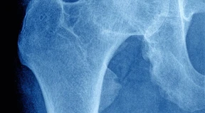 Das amerikanische Hüftgelenks-Wunder