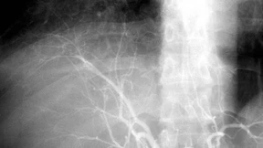 Welchen Vorteil eine Mikrowellen-Therapie bei Leberkrebs hat