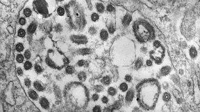 Infektionsfall mit tödlichem Marburg-Virus in Westafrika bestätigt