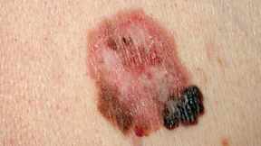 Ein tödlicher Cocktail für Melanome