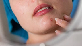 Macht Stress Pickel?