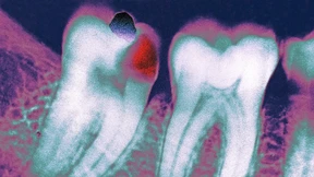 Wie sinnvoll ist ein Verbot von Amalgamfüllungen?