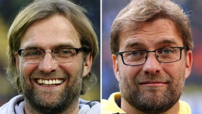 Klopp steht zu Haartransplantation