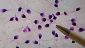 Zahl der Spermien bei Männern nimmt weltweit immer rascher ab