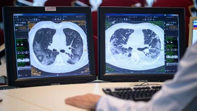 Lungenforscher testen Corona-Wirkstoff zum Inhalieren