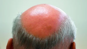 Soll die Glatze Schicksal sein?