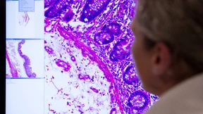 So hilft KI in der Krebsmedizin