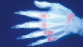 Schmerzhafte Lektion für Rheumapatienten