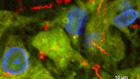 Mehr neue Syphilis- als HIV-Fälle in Europa