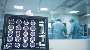 Schlaganfall – Fortschritte und Herausforderungen